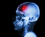 What is a Balloon Occlusion Test?