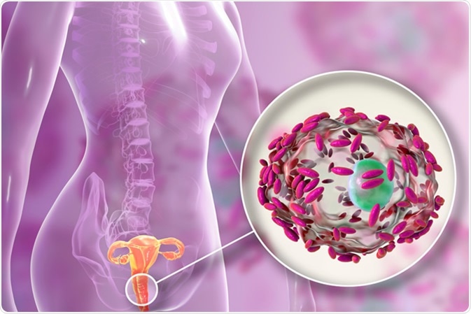 Bacterial vaginosis. Vaginal secretions contain epithelial cells, so-called clue cells covered with bacteria Gardnerella vaginalis, 3D illustration Credit: Kateryna Kon / Shutterstock