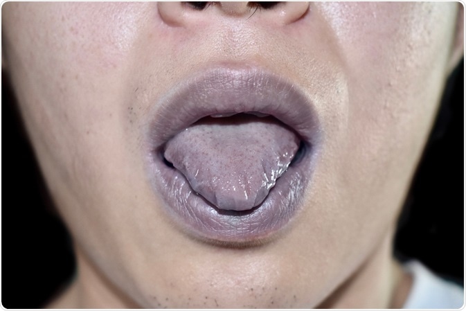 Cyanosis Cyanosis