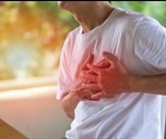Pericarditis Causes